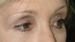 Revision Blepharoplasty - Patient 4 - After